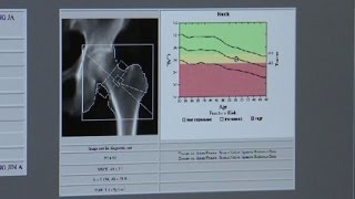 뚜렷한 증상없는 골다공증, 조기 진단해야 / YTN 사이언스