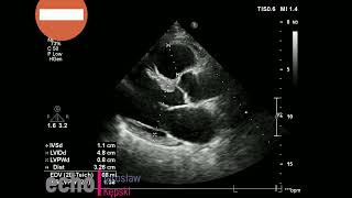 Small Perimembranous Ventricular Septal Defect #VSD  #echocardiography #echoSerca wada wrodzona