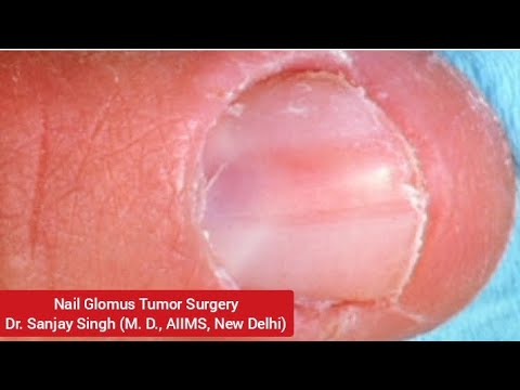 Glomus Tumor Excision #GlomusTumor #nail #Nailsurgery #skincare # ...