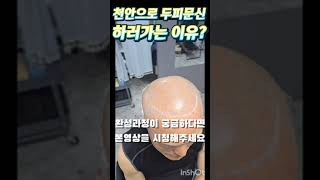 천안아산탈모극복 2025.02.09