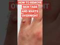 How to Remove Skin Tags and Warts Overnight #shorts #short #shortvideo