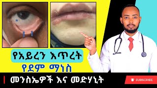 Ethiopia | የአይረን እጥረት የደም ማነስ ምልክቶች እና መፍትሄዎች