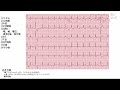 【10日で心電図がよめる】7日目 ⑩その他 j波 ε波 期外収縮