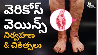 వెరికోస్ వెయిన్స్ నిర్వహణ మరియు చికిత్సలు | Best Treatments for Varicose Veins | Dr Prakash Goura