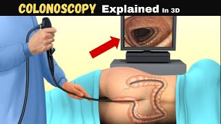 How a Colonoscopy Works –Step by Step Medical Animation #colonoscopy #colonhealth #medicalanimation