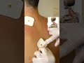 treatment for neck and back pain vuqar aslanli neckpain neckstretch headache backpain