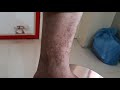 Shamberg Disease ( Dr Bhutada Skin Hair Laser Centre)