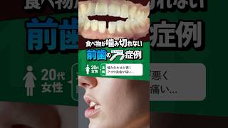 【噛み合わせ治療】前歯で食べ物が噛み切れない…そんな悩みを解決！🦷