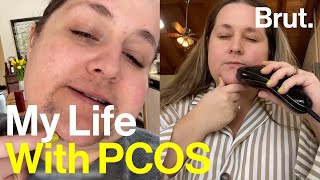 This is PCOS