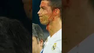 Ronaldo got bleeding injury #cr7