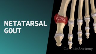 Metatarsal Gout | by Complete Anatomy