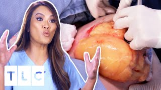 Dr Lee Removes The LARGEST Lipoma She's Ever Seen! | Dr Pimple Popper | UNCENSORED | 18+
