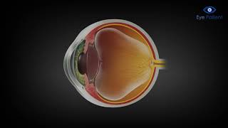 Vitreomacular Adhesion- Medication Injection | Free Eye Patient App