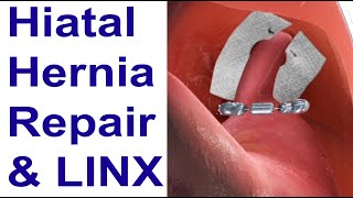 Hiatal Hernia Repair & LINX to Treat Reflux Animation