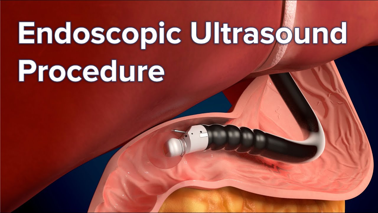 Endoscopic Ultrasound (EUS) Procedure | Cincinnati Children's