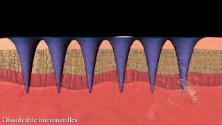 Dissolvable microneedles 'Mechanism of action'