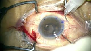 Yamane scleral fixated IOL for beginner 9.0: First yamane for the surgeon: excellent surgery