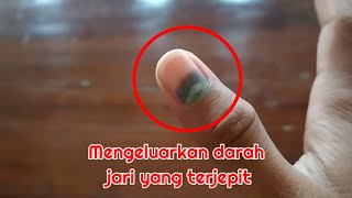 tips kuku jari terjepit dan mengurangi rasa sakit yang ditimbulkanya, yuk disimak