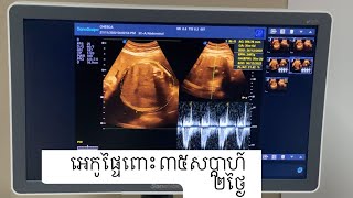 អេកូផ្ទៃពោះ ៣៥សប្តាហ៍ ២ថ្ងៃ pregnancy ultrasound 35week 2day by Dr.IM SOKLEAN