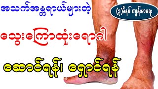 အသက်အန္တရာယ်များတဲ့ သွေးကြောထုံး ရောဂါ၊ ဆောင်ရန်ရှောင်များ၊ How to prevent Varicose Vein