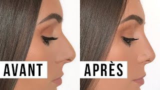 MA RHINOPLASTIE : AVANT/APRÈS, PRIX, EXPÉRIENCE etc.│PerfectHonesty