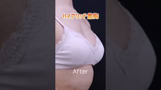 【痩せ型でも美乳に】ハイブリッド豊胸【湘南美容クリニック】【新宿本院院長 中村大輔】#美容整形 #豊胸 #巨乳 #爆乳 #シリコンバッグ豊胸 #コンプレックス