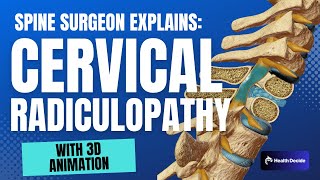 An Orthopedic Surgeon's Guide: Cervical Radiculopathy
