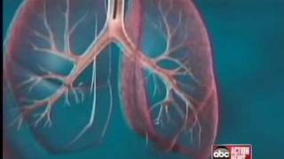 New treatment targets asthma sufferers