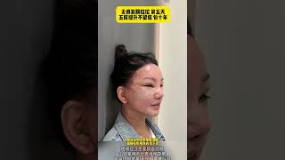 #无痕筋膜提升 #抗衰老 #拉皮 #facelift #trending #PlasticSurgeon #fyp #面部提升 #整形 #松弛下垂 #viralvideo