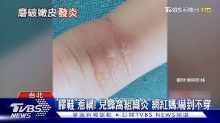 「膠鞋」惹禍! 兒蜂窩組織炎 網紅媽:嚇到不穿｜TVBS新聞 @TVBSNEWS01