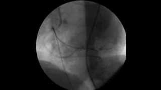 DR.SHKELQİM HOXHA:ACUTE İNFERİOR MİOCARD İNFARCTİON :PTCA+STENT WİTH PERMANENT PACEMAKER