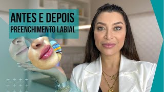 Preenchimento labial antes e depois (dicas: produto mais seguro, dói ?, quantidade)