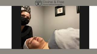 eDermastamp Microneedling