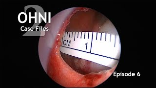 Man with (HHT) has a SEPTAL PERFORATION REPAIR SURGERY
