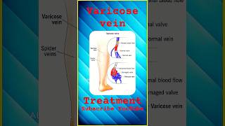 #varicoseveins  நீங்கள், நீண்ட நேரம் நிற்பவரா❓ - இனிமேல் அந்த தவற செய்யாதீங்க❌ #shorts #shortsfeed