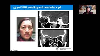 Lecture: Evidence Based Management of Lacrimal Gland Tumors