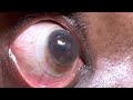 eyeprint pro scleral lens over an eye with advanced keratoconus with hydrops