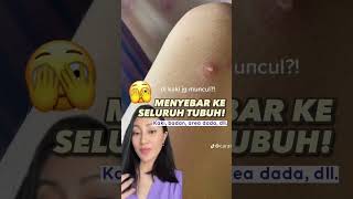 BUKAN JERAWAT tapi TERNYATA… | dr. Clarin Hayes