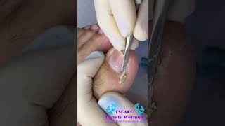 UNHA ENCRAVADA INGROWN TO REMOVE NAIL  [Renata Werneck Podóloga - Unha Encravada] TOE BRO #shorts