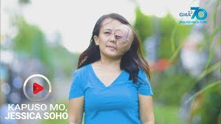 Kapuso Mo, Jessica Soho: Babae, namula at namaga ang mata nang dahil sa contact lenses?