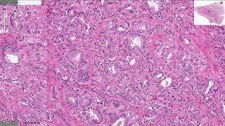 Prostatic Adenocarcinoma - Histopathology