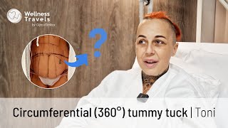 Circumferential (360°) tummy tuck in Lithuania | Toni's experience | Medical Tourism