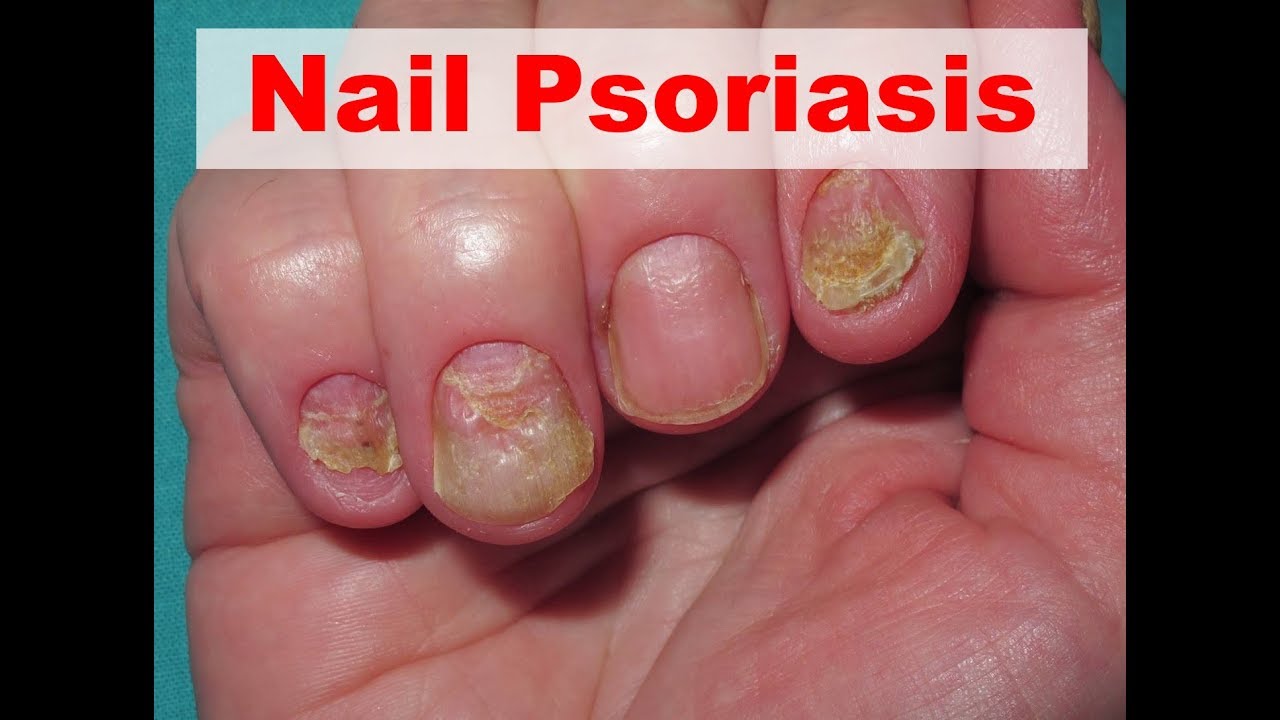 Nail Psoriasis - What Exactly Is Nail Psoriasis - YouTube