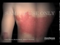 adn dna.net 0326 psoriasis