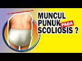 Kenapa Muncul Punuk pada Skoliosis ? - Fisioterapi Mandala