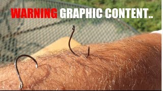 Top 3 Best Ways To Remove Fishing Hooks (GRAPHIC CONTENT)