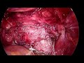 laparoscopic sacrocolpopexy for vaginal vault prolapse dr. imran abdullah khan