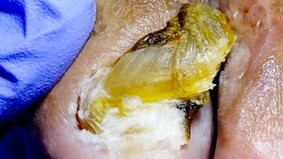 The Lifting Onychomycosis Can Restore The Toenails To Healthydoctor Liu Pedicure