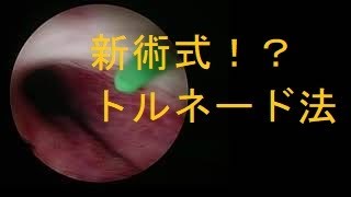 HOLEP手術動画　ゆっくり解説動画　15例目　逆順行性en bloc HOLEP