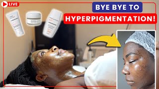 The ULTIMATE Peel For Dark Skin: My Cosmelan Experience Treating Dark Spots \u0026 Hyperpigmentation